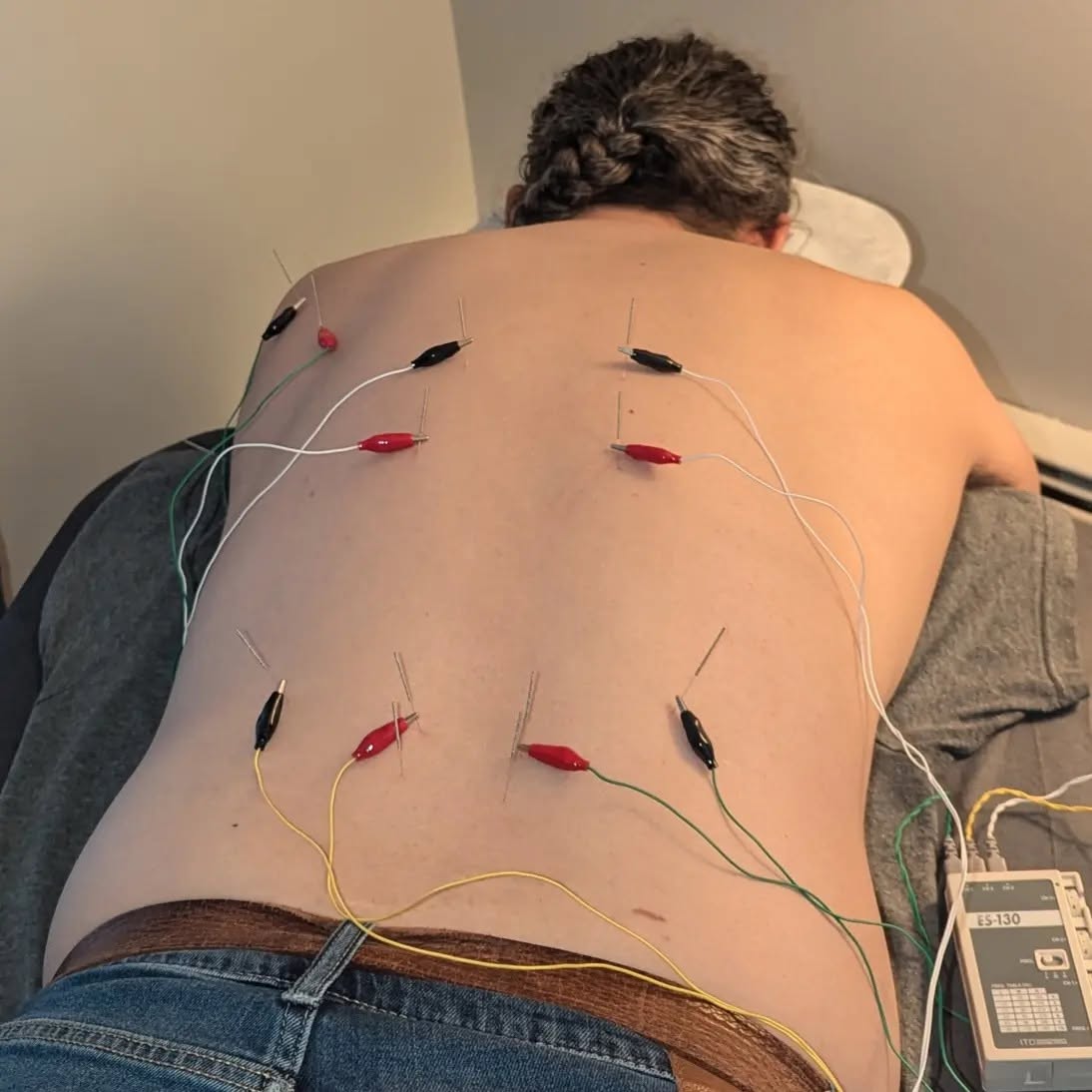 Acupuncture in Lansdale, PA - July 28th, 2026