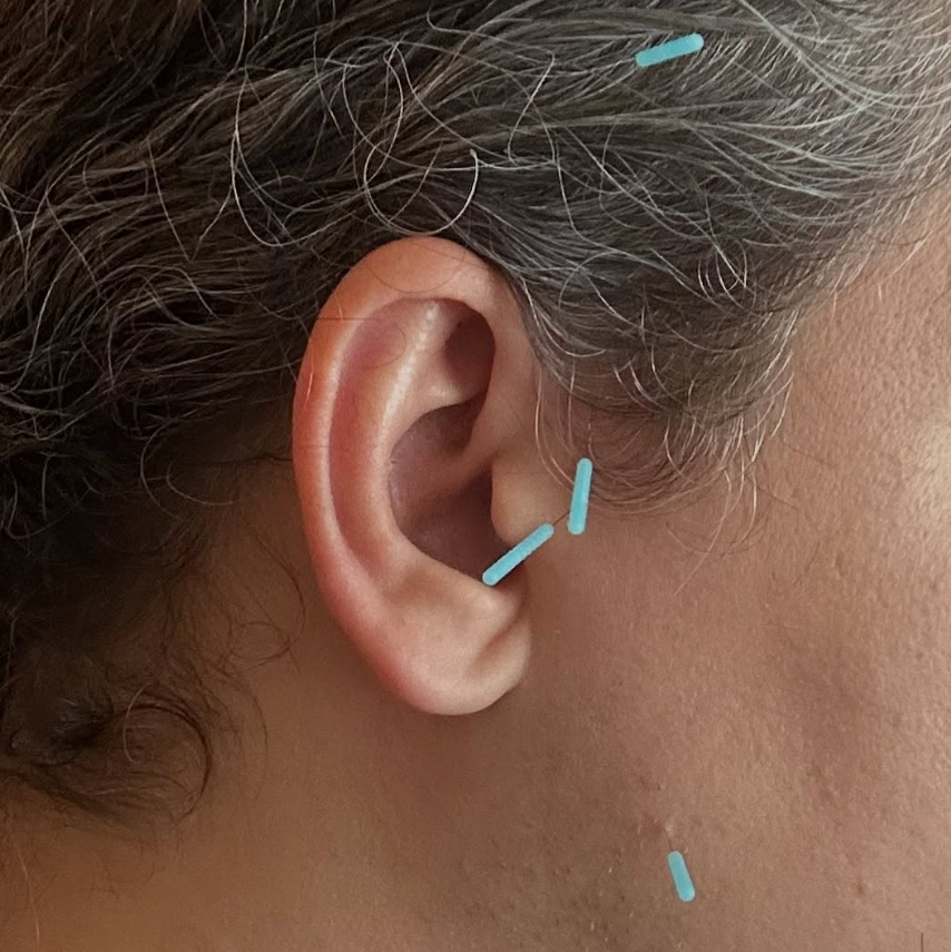 Cosmetic Acupuncture and Microneedling in Lansdale, PA - July 28th, 2026